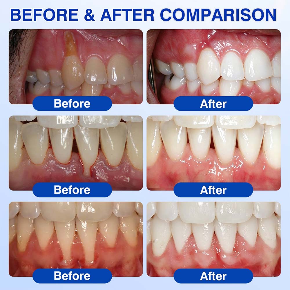 🦷 Healrize® GumRevive Periodontal Repair Gel (for bleeding gums, receding gums, and loose teeth)🐳