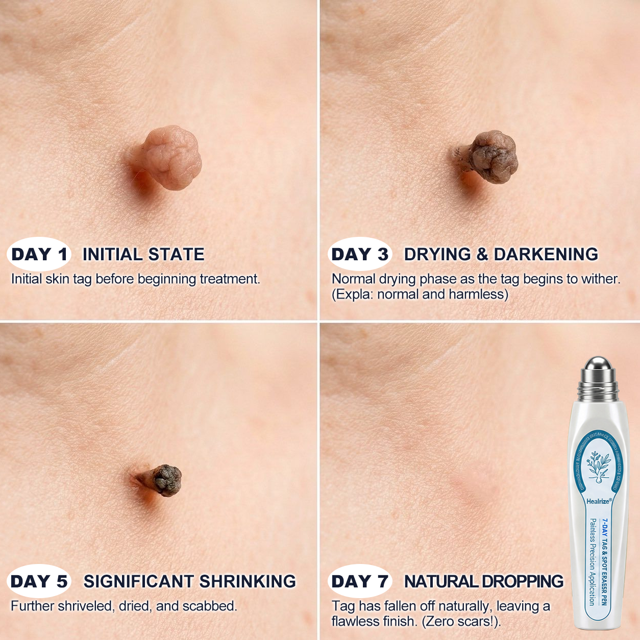 𝐇e𝐚𝐥𝐫i𝐳e® 7-𝐷𝑎𝑦 𝗧𝐚𝐠 & 𝗦𝗽𝐨𝐭 𝐄𝐫𝒂𝒔𝒆𝒓(Zero Pain, Zero 𝐒𝐜𝐚𝒓𝒔 Rollerball) 💝